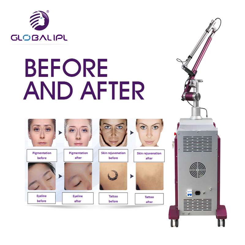Q-Switch ND YAG Laser Tattoo Removal Pigment Therapy Beauty Machine